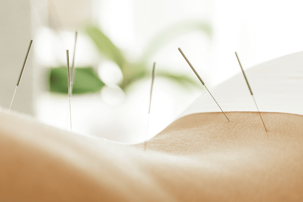 An example of acupuncture therapy.