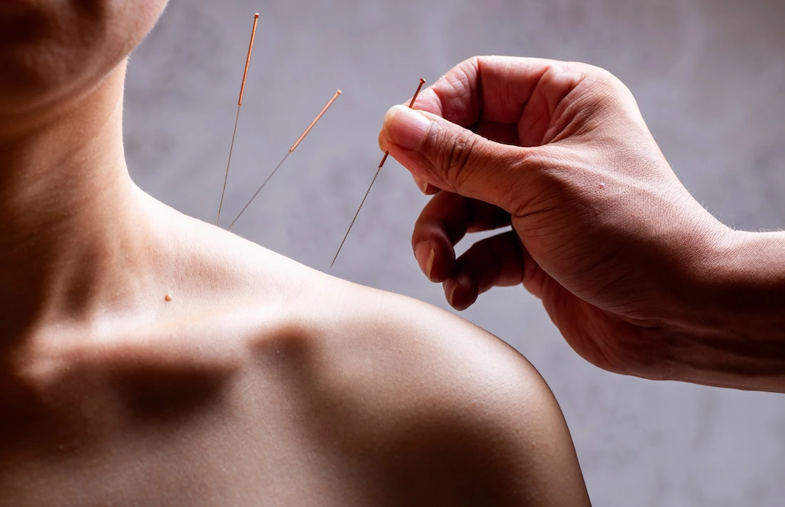 A provider performs acupuncture to help a client with alcohol addiction.